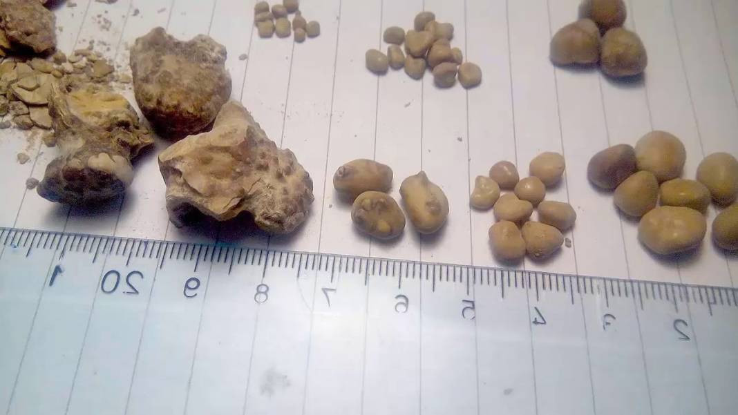 Havalar ısındı böbrek taşına dikkat! Uzman isim uyardı - Resim: 18